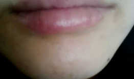 吃瓜嘴角红疙瘩,嘴角红疙瘩揭秘